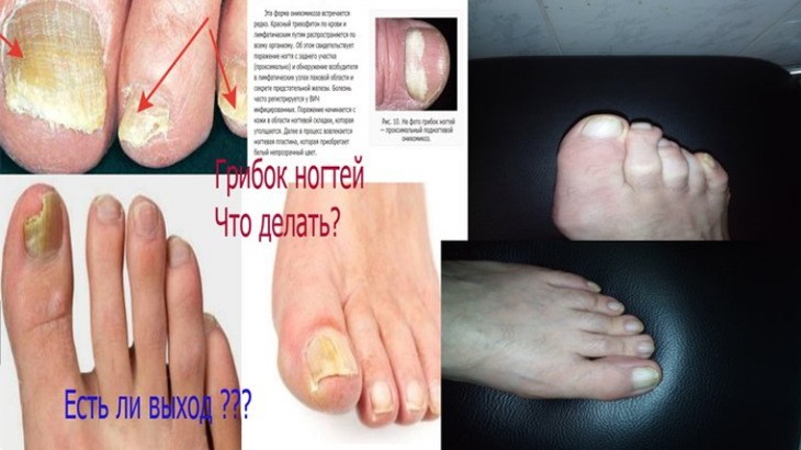 Заболевание грибок ногтей.Как вылечить грибок ногтей обычным уксусом?Проверено на себе